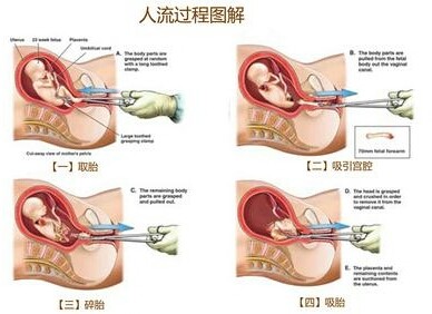 引产半个月后小腹疼痛，原因、处理与后续照顾