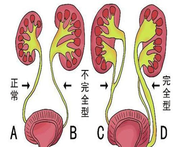 六个月宝宝尿路感染的识别与处理