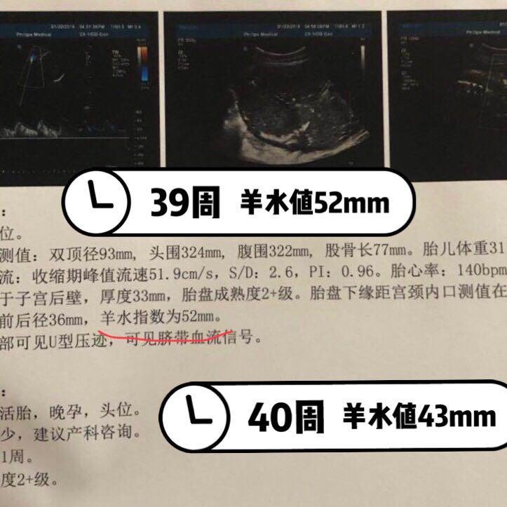 孕5个月有褐色分泌物的关注与理解